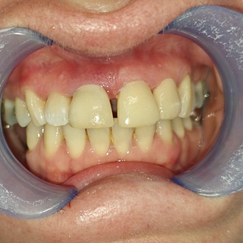 Centralising teeth - after
