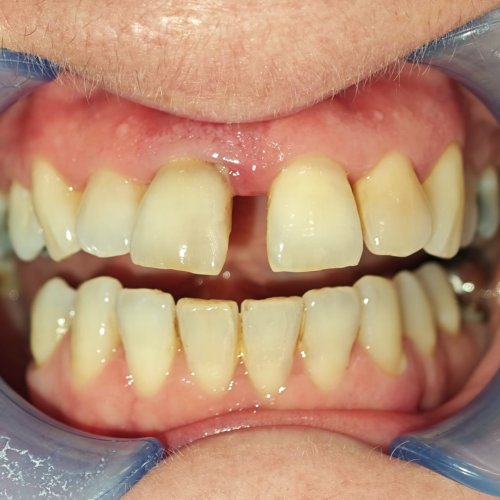 Centralising teeth - before