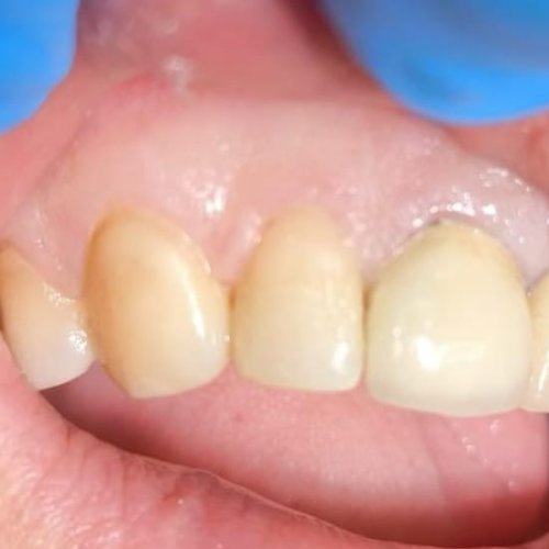 Dental Filling - After