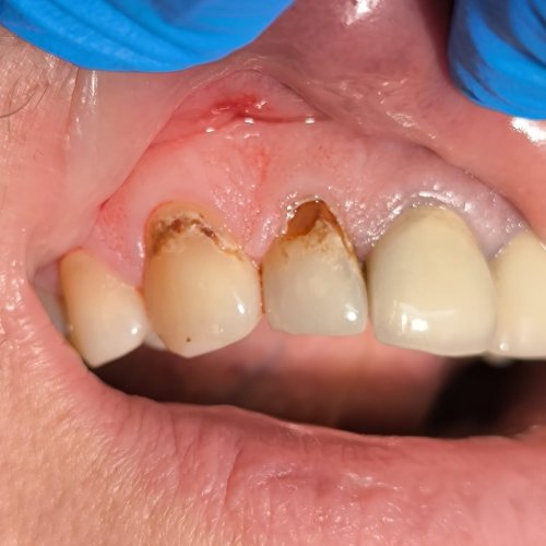 Dental Filling - Before