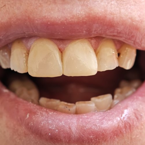 Dental Restoration - after
