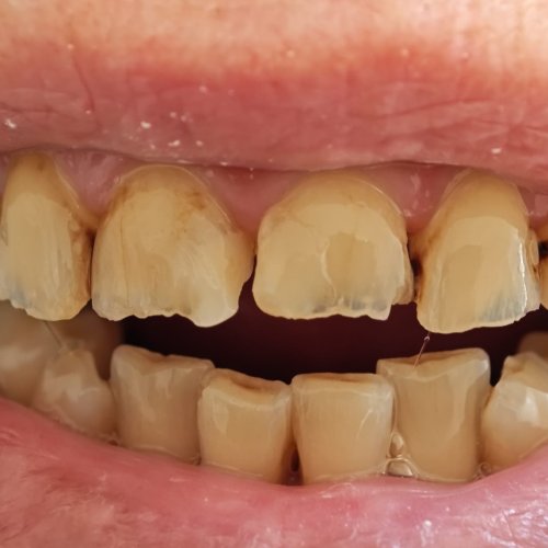 Dental Restoration - before