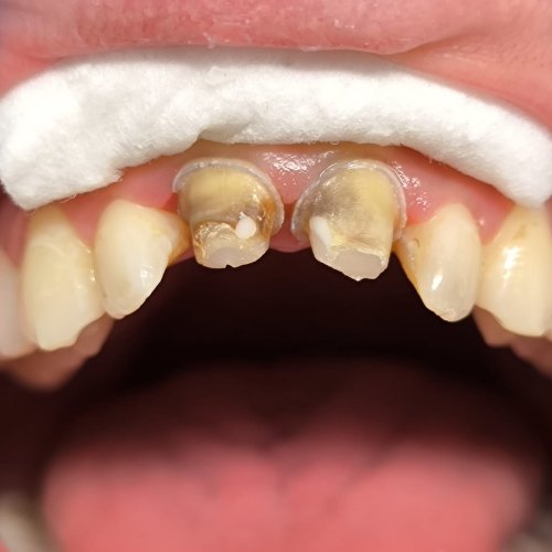 Dental Crown - before