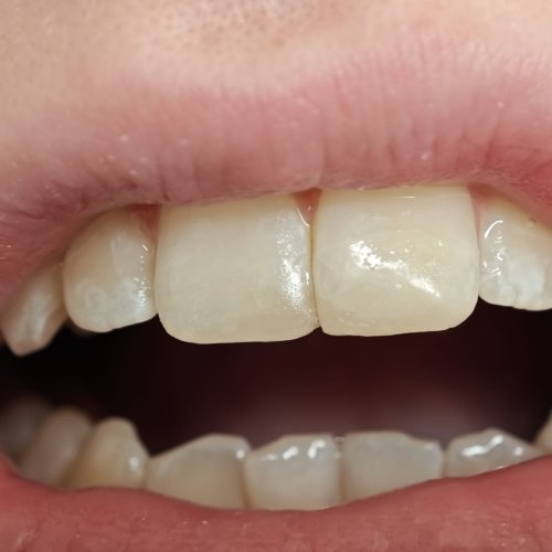 Orthodontics - after