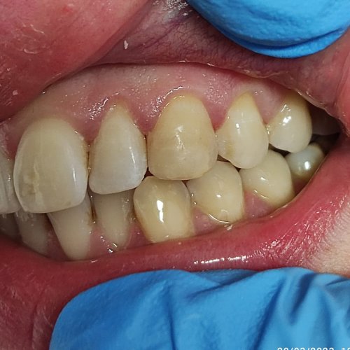 Orthodontics - before