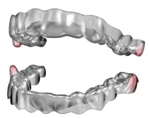 Smart Aligners