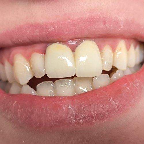 Dentall Crown - after