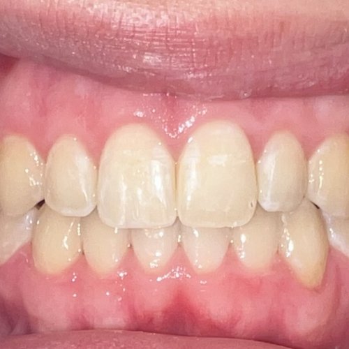 Orthodontics 2 - after