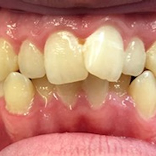 Orthodontics 2 - before