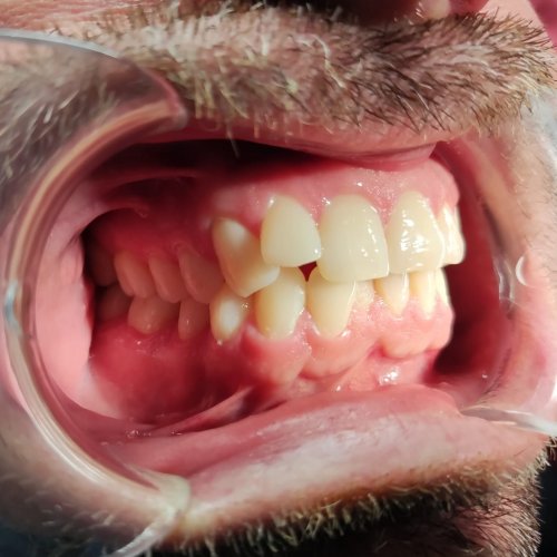 Orthodontics - before
