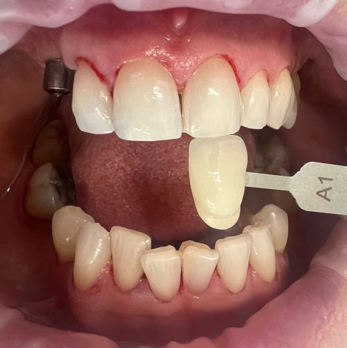 Tooth Whitening - after